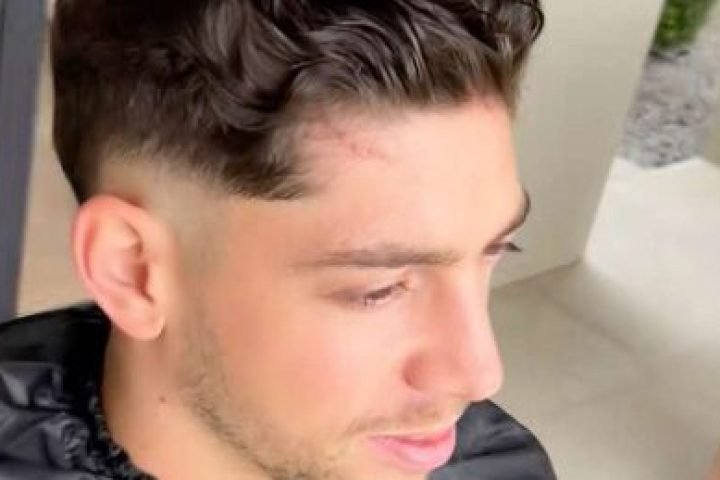 Cicatriz de Valverde após briga com Tchouameni — Foto: Cicatriz de Valverde após